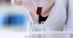 Trop de dépistage du cancer de la prostate ?