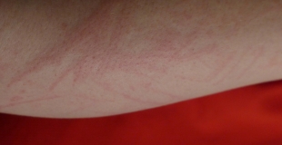 Allergies cutanées : quels allergènes ? Précautions et traitements