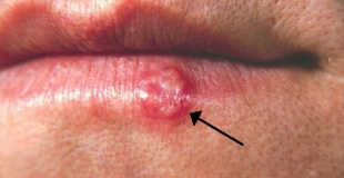 Le bouton de fièvre : qu'est-ce que c'est, comment le soigner ?