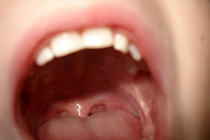 Comment soigner les aphtes avec des remèdes naturels ?