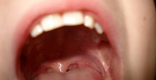 Comment soigner les aphtes avec des remèdes naturels ?