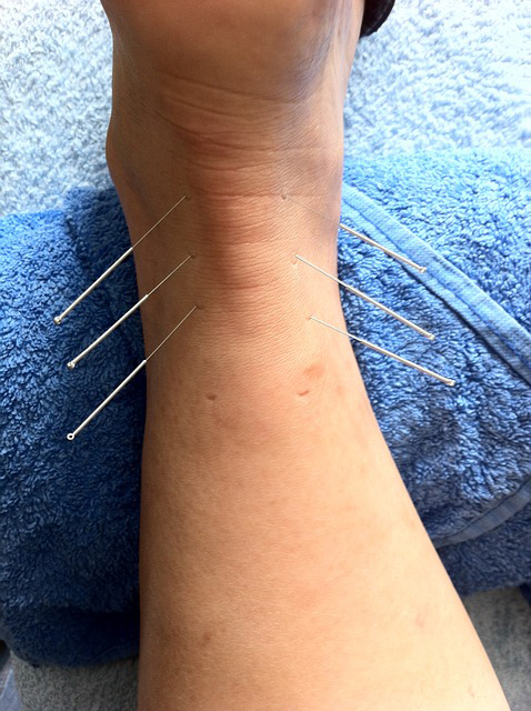 acupuncture pour signer un lumbago