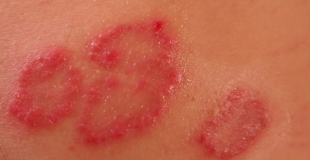 Les 3 problèmes de peau les plus courants chez les bébés