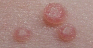 Le moluscum : définition, le reconnaitre et comment le traiter